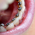 dental braces in dubai | dental braces in dubai | invisalign braces dubai | invisible braces dubai